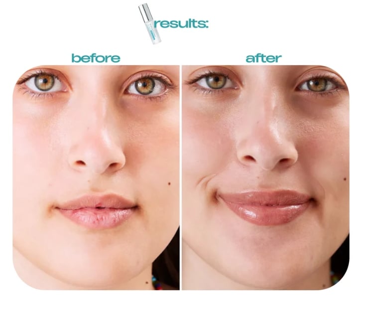 Varche™ Shot pour les lèvres repulpantes aux spicules